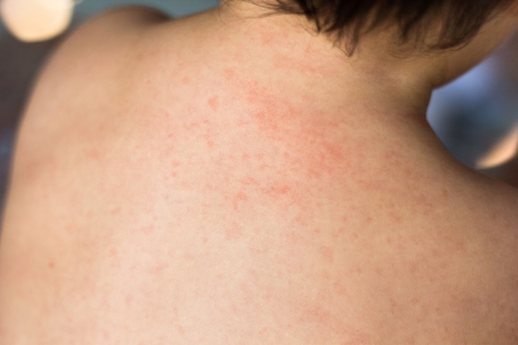 Chăm sóc sốt phát ban tại nhà đúng cách