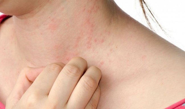 Điều trị sốt phát ban ở người lớn như thế nào?