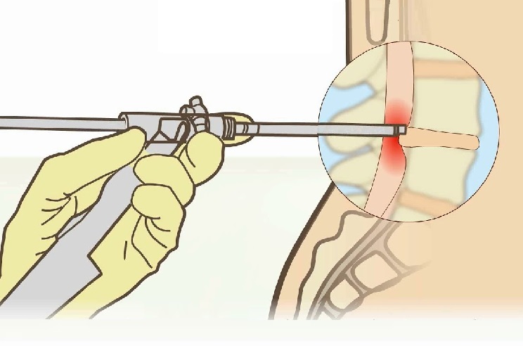 Càn điều trị sớm bằng thuốc hoặc các phương pháp vật lý trị liệu