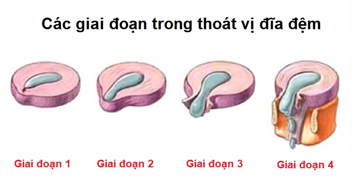 các giai đoạn Thoát vị đĩa đệm