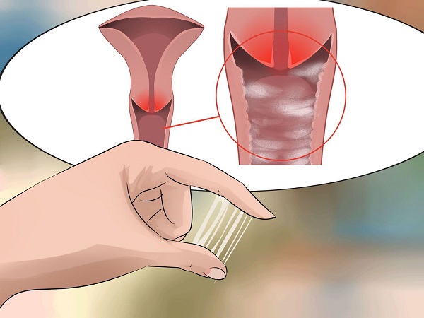 Khí hư ra nhiều, mùi hôi tanh, màu xám là dấu hiệu của ung thư cổ tử cung