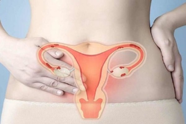 Có nhiều yếu tố làm tăng nguy cơ ung thư cổ tử cung