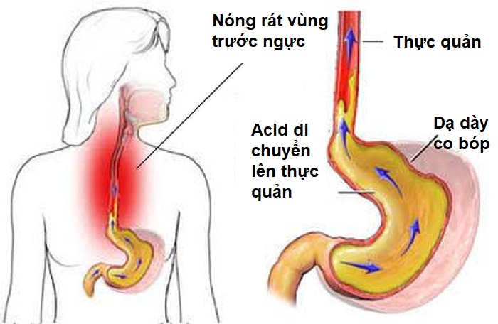 Trào ngược dạ dày - thực quản có thể dẫn đến viêm họng