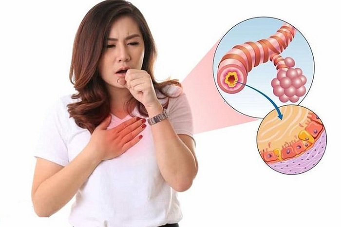 Ho là triệu chứng không đặc hiệu khi bị viêm phế quản co thắt