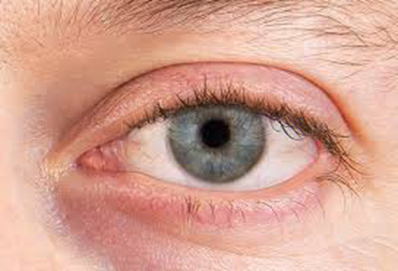 Triệu chứng của khô mắt