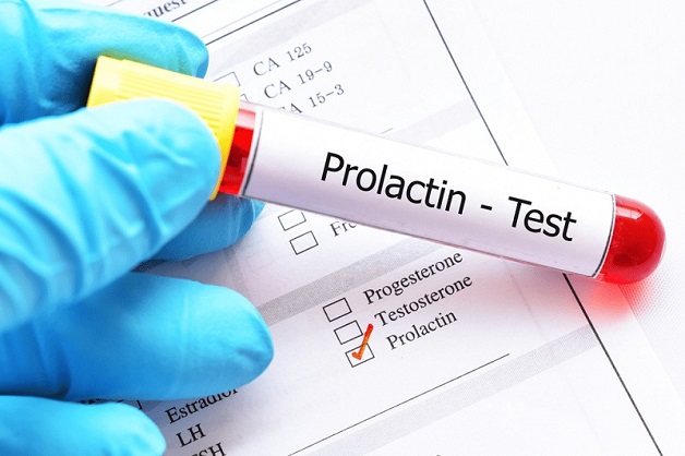 Prolactin cao có thể gây vô sinh