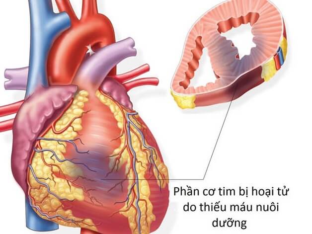 Bệnh mạch vành gây biến chứng nhồi máu cơ tim 
