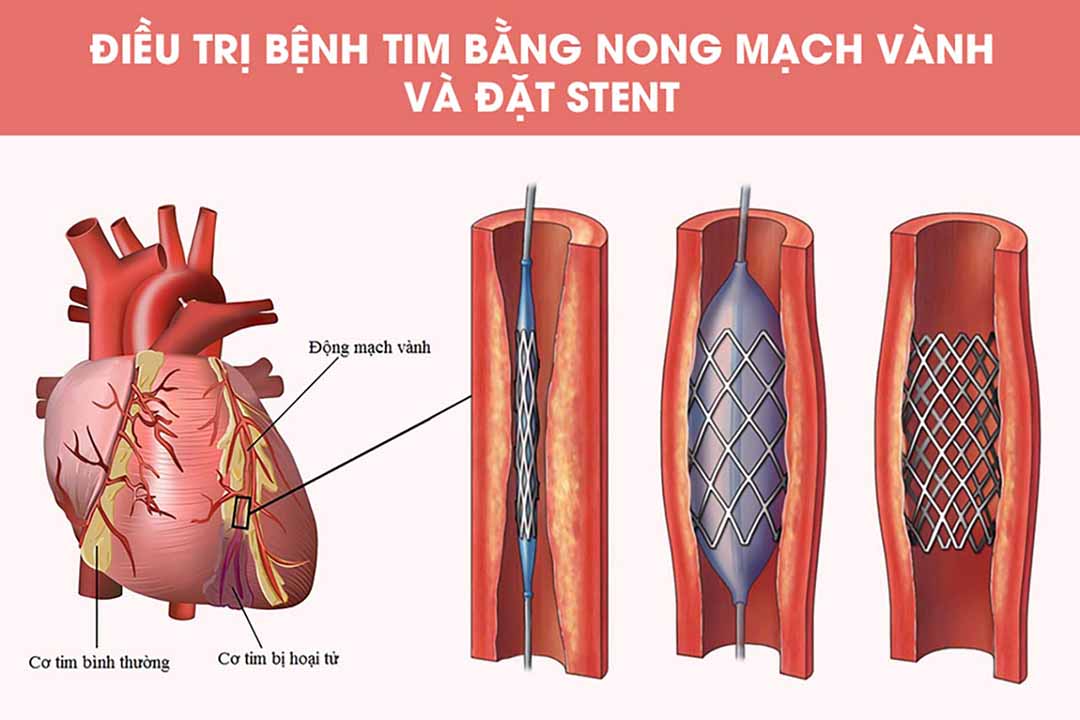 Nong và đặt stent mạch vành
