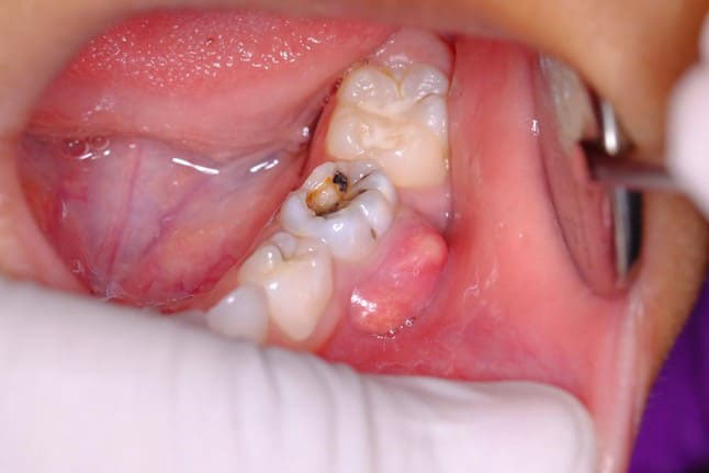 Biến chứng của sâu răng là gì?