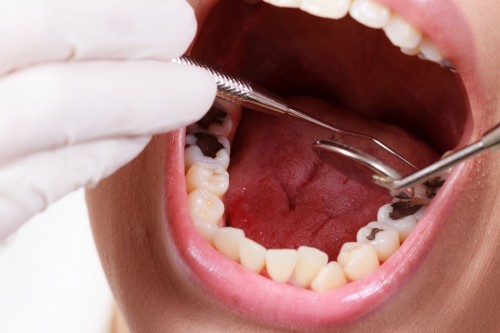 Điều trị sâu răng như thế nào?