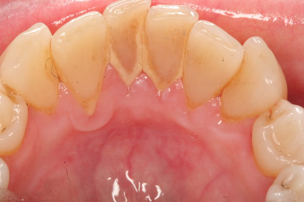 Sâu răng hình thành như thế nào?