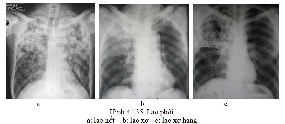 Hình ảnh X-quang lao phổi