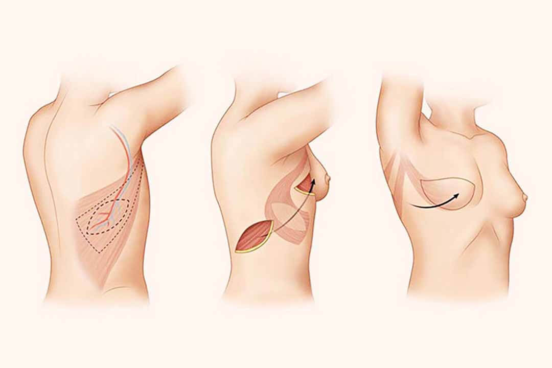 Phẫu thuật tạo hình và tái tạo tuyến vú