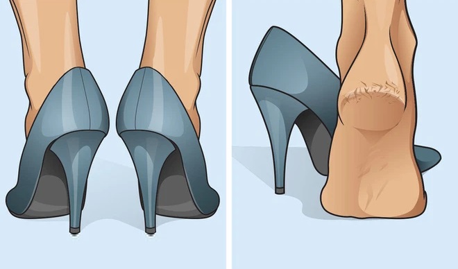 Thường xuyên đi giày cao gót cũng có thể dẫn đến nứt gót chân
