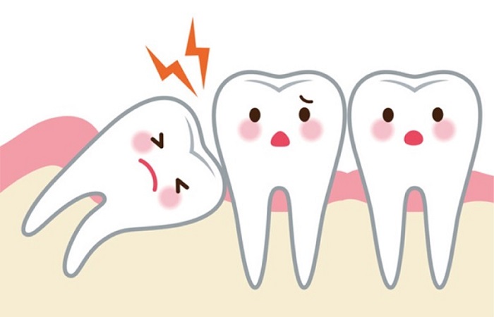 Cần nhổ răng khôn khi răng khôn mọc lệch
