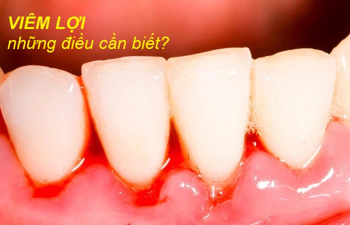 Viêm lợi là bệnh răng miệng khá phổ biến