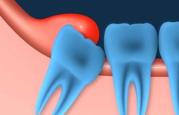 Lợi trùm không tiêu biến khi mọc răng là một trong những nguyên nhân gây viêm