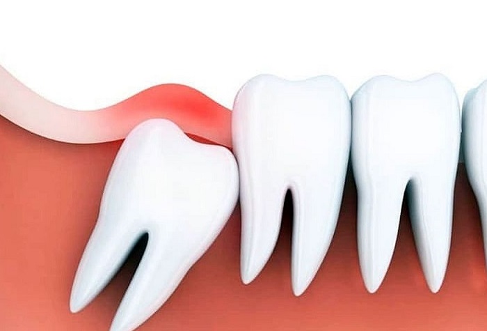 Viêm lợi trùm là tình trạng dễ gặp phải khi lên răng khôn