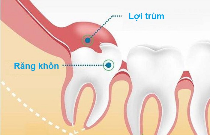 Viêm lợi trùm là căn bệnh liên quan đến sự phát triển của răng khôn
