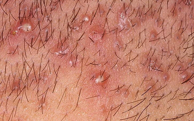 Hình ảnh của viêm nang lông vùng kín