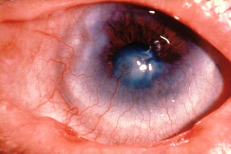 Sẹo đục giác mạc do mắt hột (Corneal Opacity)