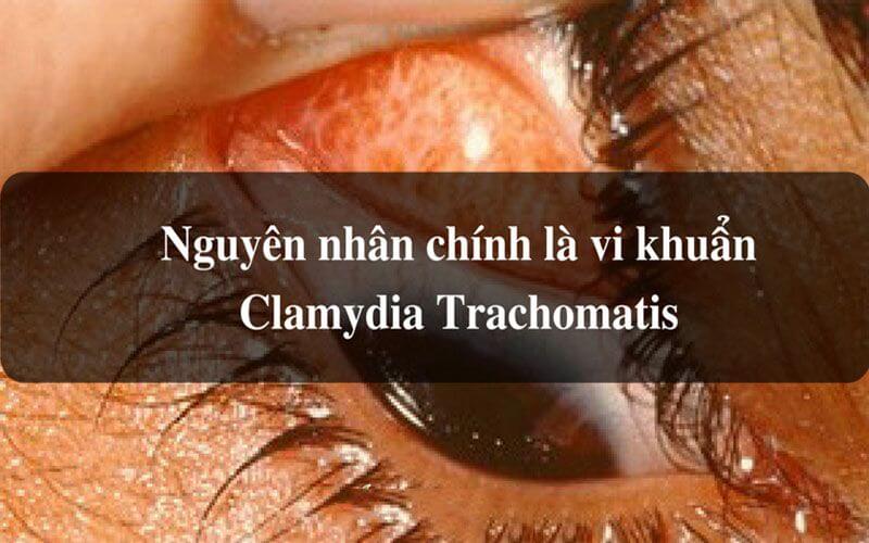 Chlamydia Trachomatis là nguyên nhân chính gây đau mắt hột