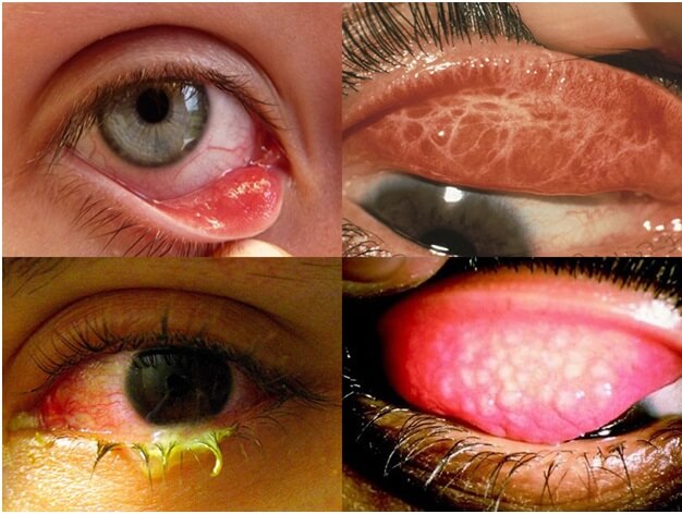 Một số triệu chứng của đau mắt hột