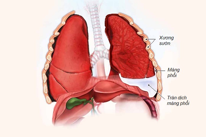 Lao phổi có thể gây tràn dịch màng phổi