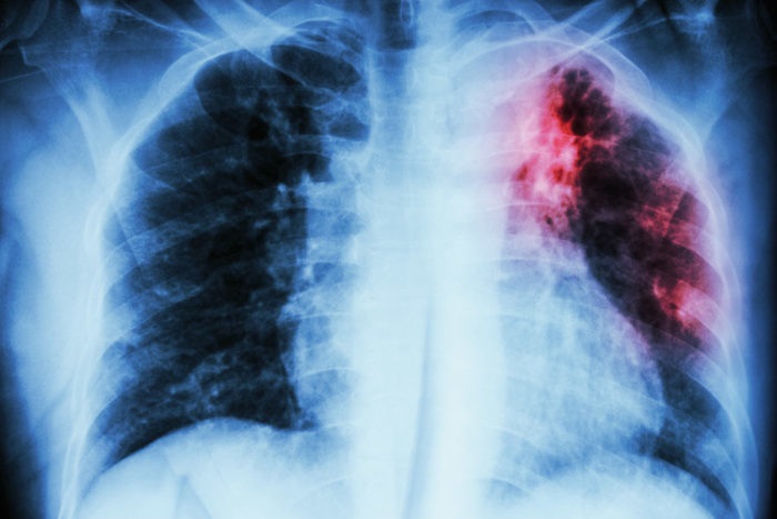 Có thể chẩn đoán lao phổi qua chụp X-quang