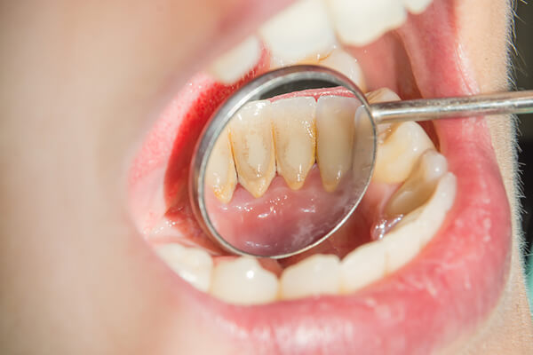 Quá trình hình thành cao răng như thế nào?