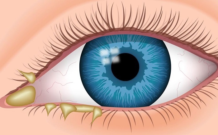 Mắt đổ ghèn là dấu hiệu cảnh báo những vấn đề về mắt