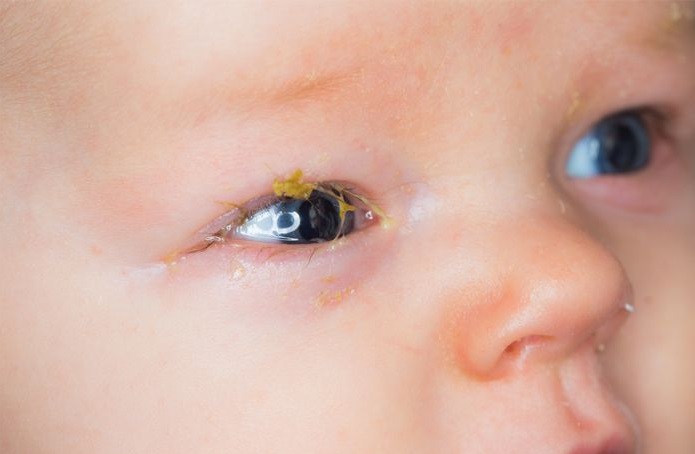 Mắt đổ ghèn có thể do viêm nhiễm ở mắt hoặc có dị vật trong mắt