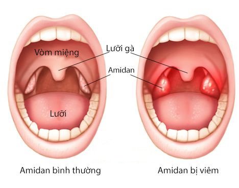 viem_amidan_la_gi