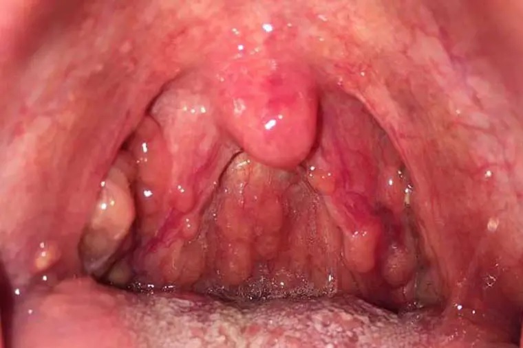 viêm họng gây niêm mạc sưng đỏ
