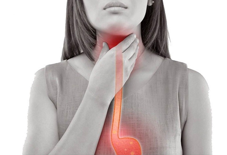 trào ngược dạ dày thực quản gây viêm họng