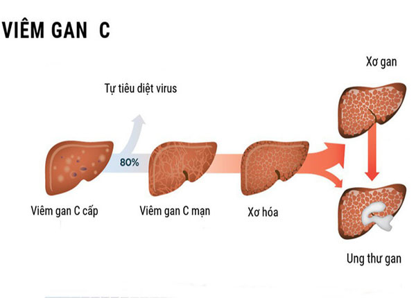 dien-bien-benh-viem-gan-c-qua-cac-giai-doan