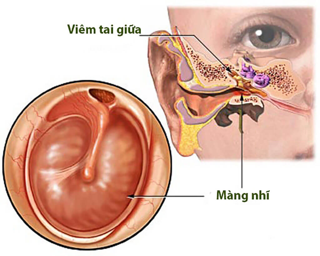 Viêm tai giữa nên ăn gì và kiêng ăn gì?
