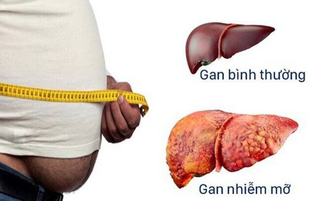 Gan nhiễm mỡ có phải chỉ gặp ở người béo phì?