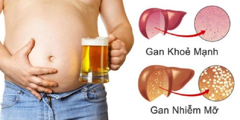 Lạm dụng rượu dẫn đến nguy cơ cao bị gan nhiễm mỡ