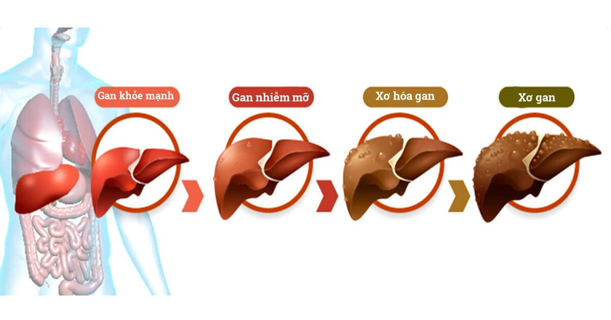 Nếu không được điều trị gan nhiễm mỡ tiến triển thành xơ gan