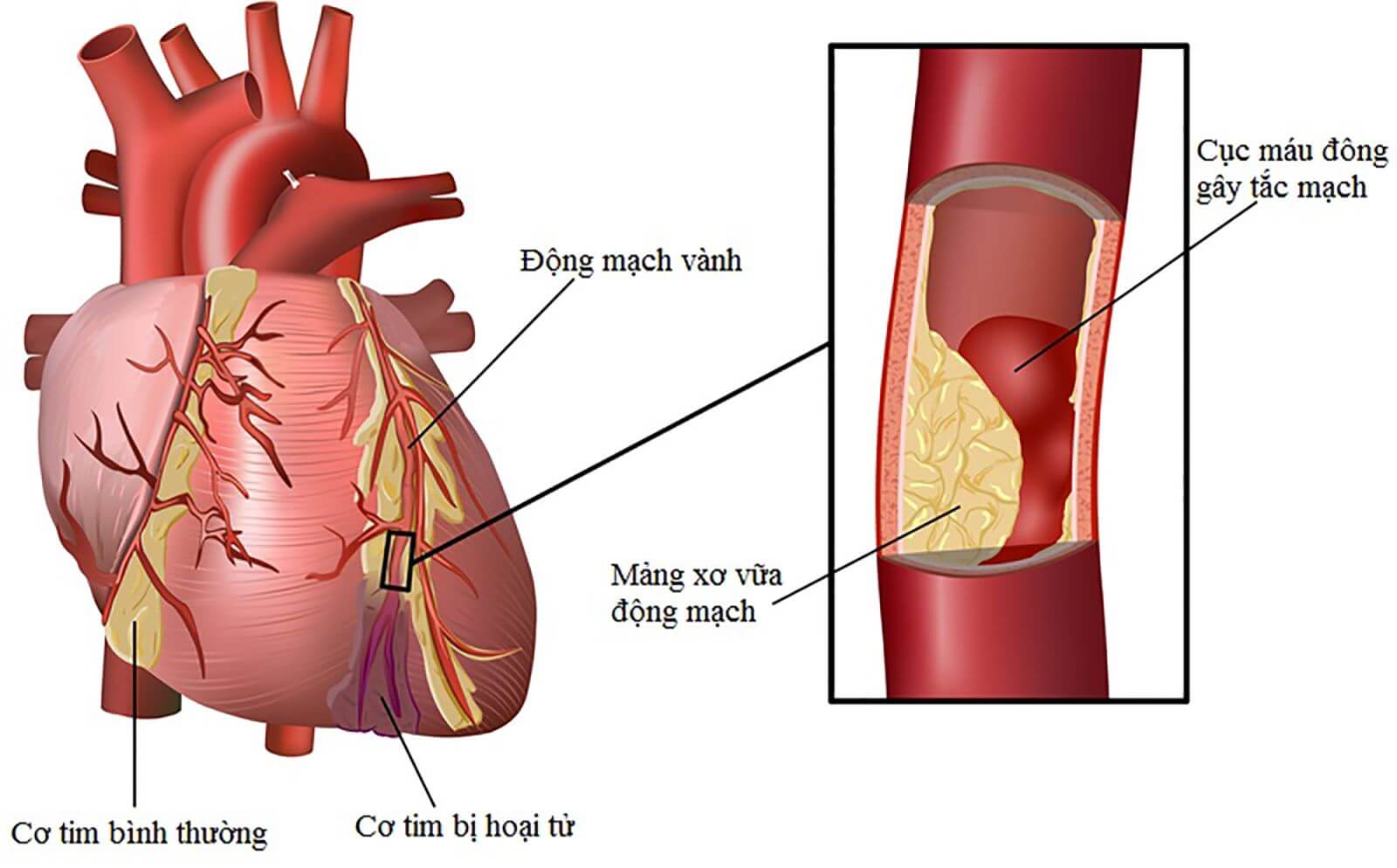 Tăng huyết áp dẫn đến bệnh tim