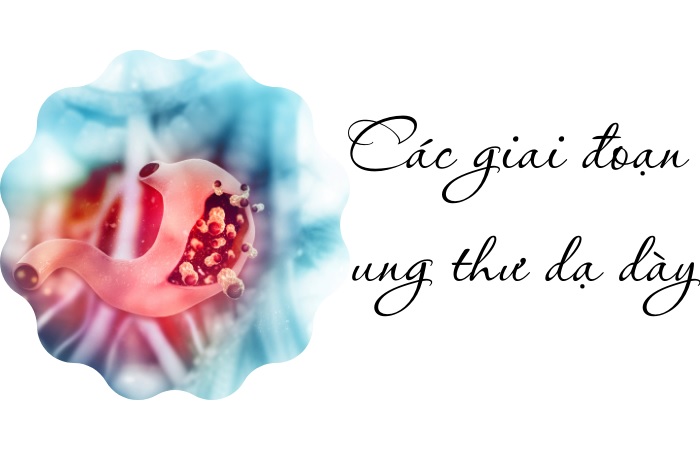 Các giai đoạn của ung thư dạ dày