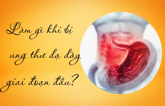 Cần làm gì khi bị ung thư dạ dày giai đoạn đầu?