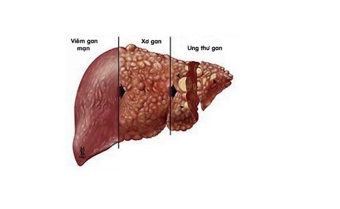 Không phải ai cũng bị xơ gan, ung thư gan khi nhiễm HBV