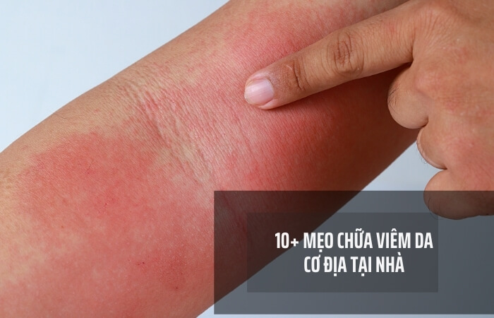 mẹo chữa viêm da cơ địa