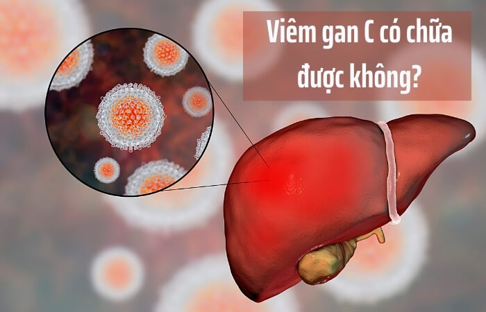 Viêm gan C có chữa được không?