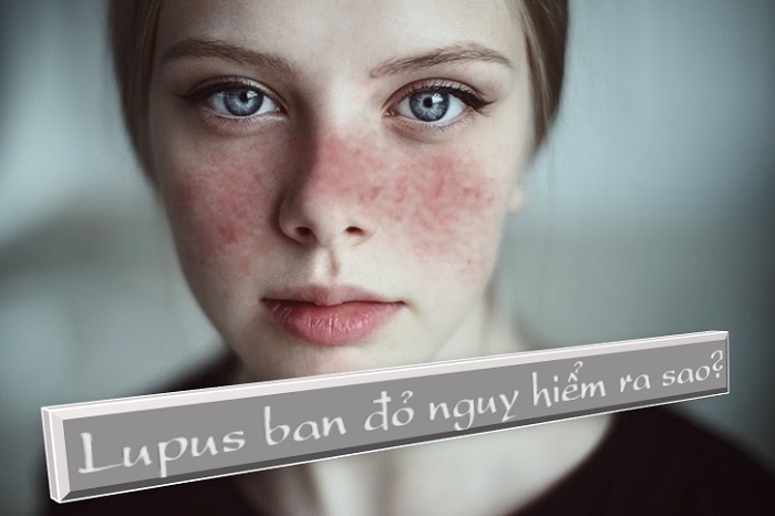 Bệnh lupus ban đỏ 