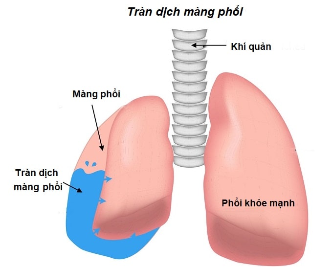 Tràn dịch màng phổi là bệnh lý nguy hiểm