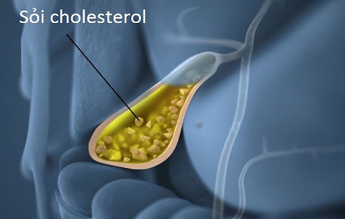 Chế độ ăn giàu Cholesterol là nguyên nhân gây sỏi túi mật